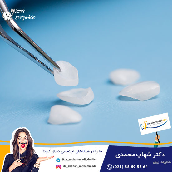 لمینت برلیانس چیست و چه مزایایی دارد؟ - کلینیک دندانپزشکی دکتر شهاب محمدی